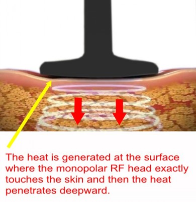 Cong nghe giam beo monopolar RF