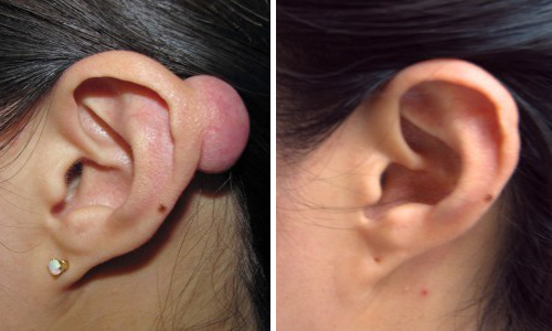 Máy laser co2 Be cell - Đột phá về công nghệ trị sẹo & tái tạo da 3 seo loi dai tai minh hoa 3