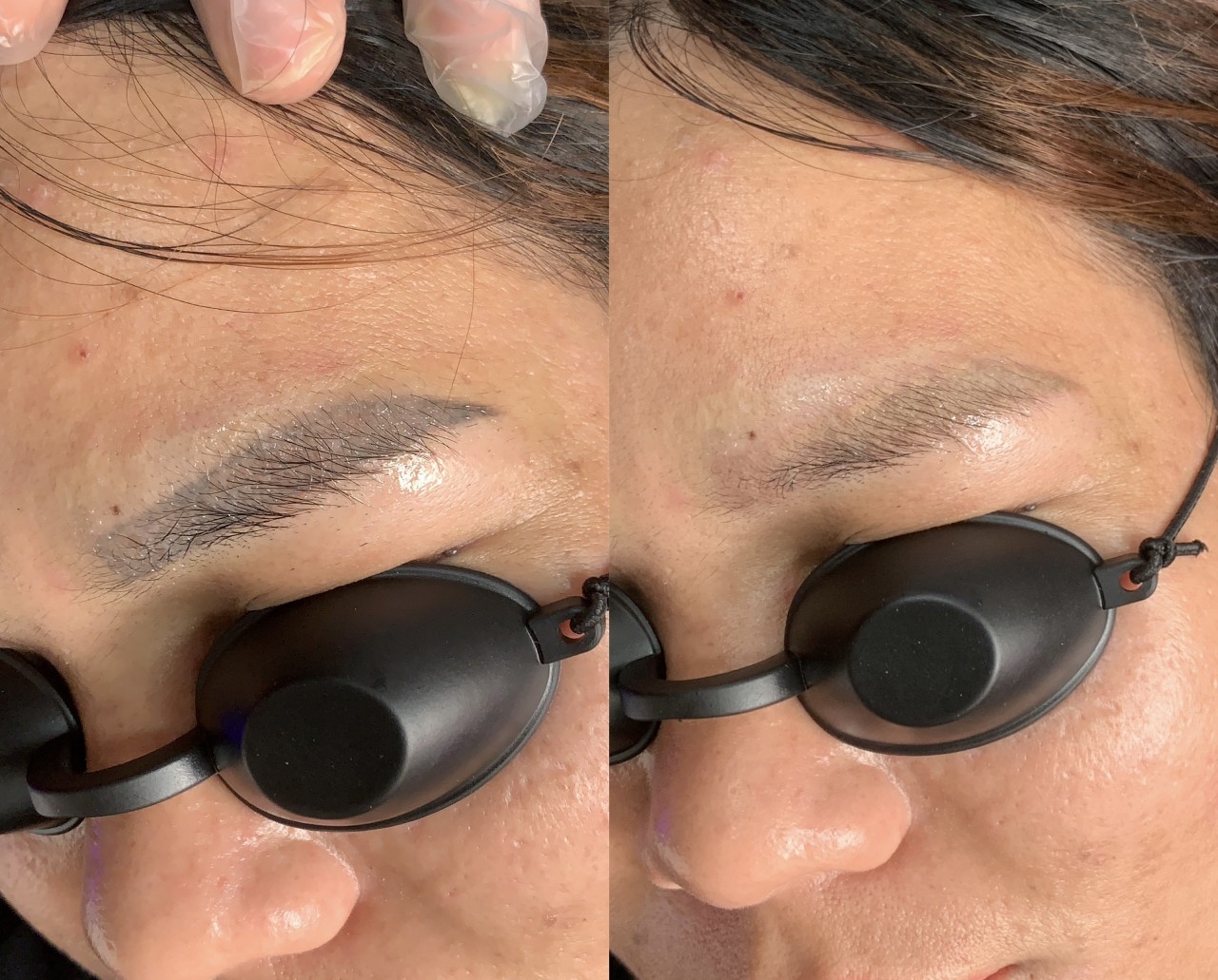 Máy Laser Xóa Xăm Pico Ruka 4 máy xóa xăm pico ruka