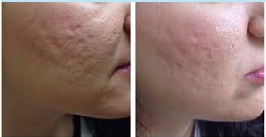 Máy laser co2 Be cell - Đột phá về công nghệ trị sẹo & tái tạo da 4 máy laser co2