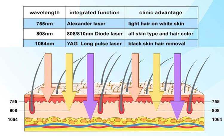 máy triệt lông diode laser