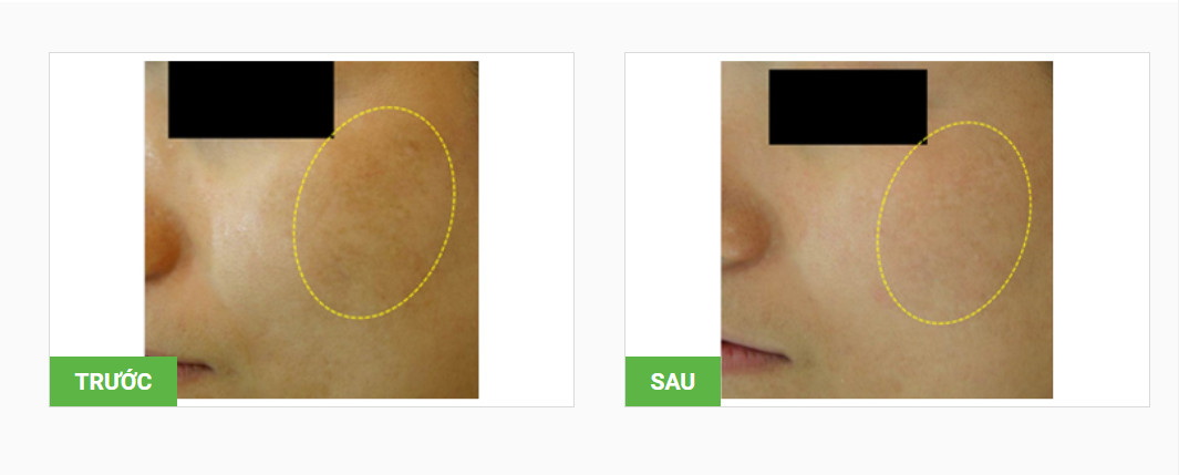 máy xóa xăm trị nám