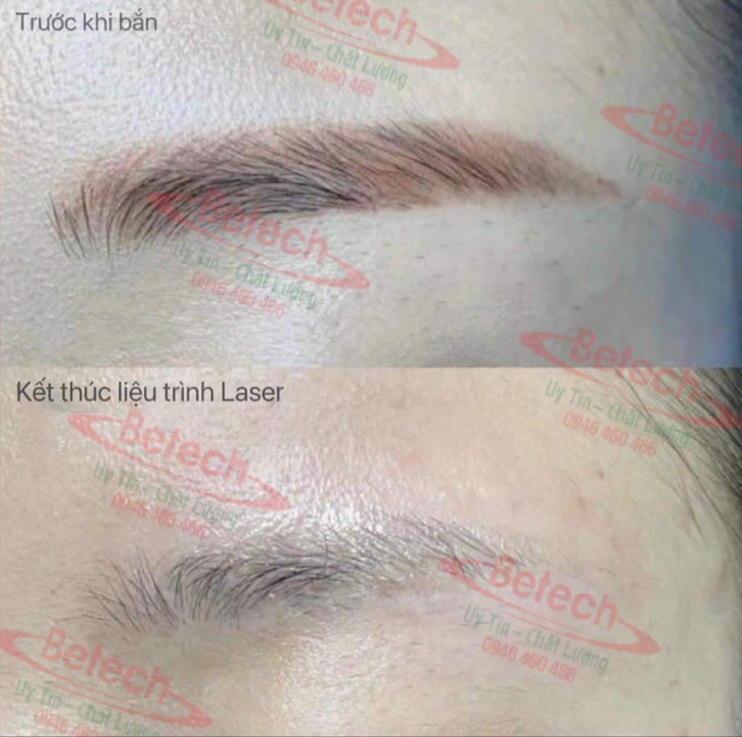 Máy Laser Pico ProMax Plus Chính Hãng 5 20240406 202938