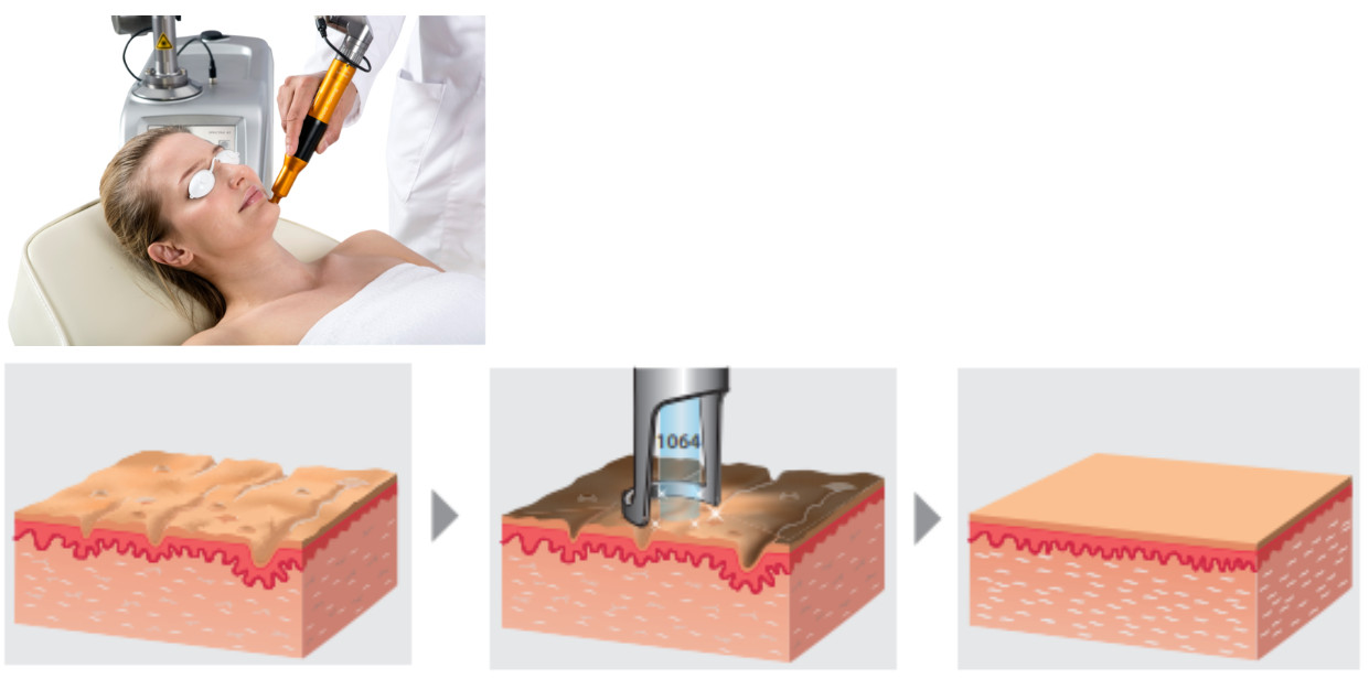 Máy xóa xăm trị nám