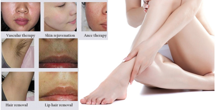 máy triệt lông công nghệ DPL