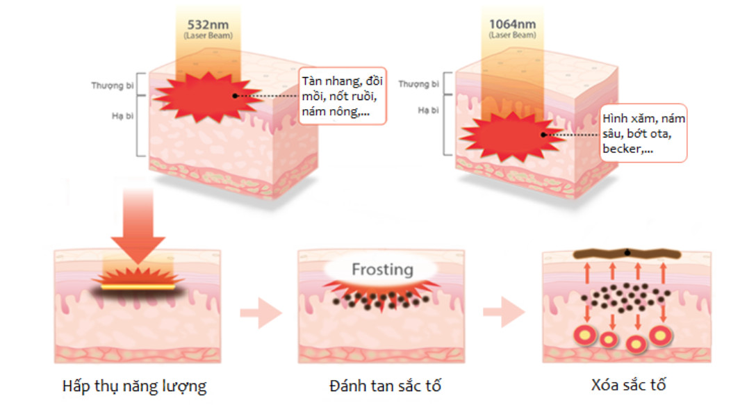 máy laser xóa xăm Nano X