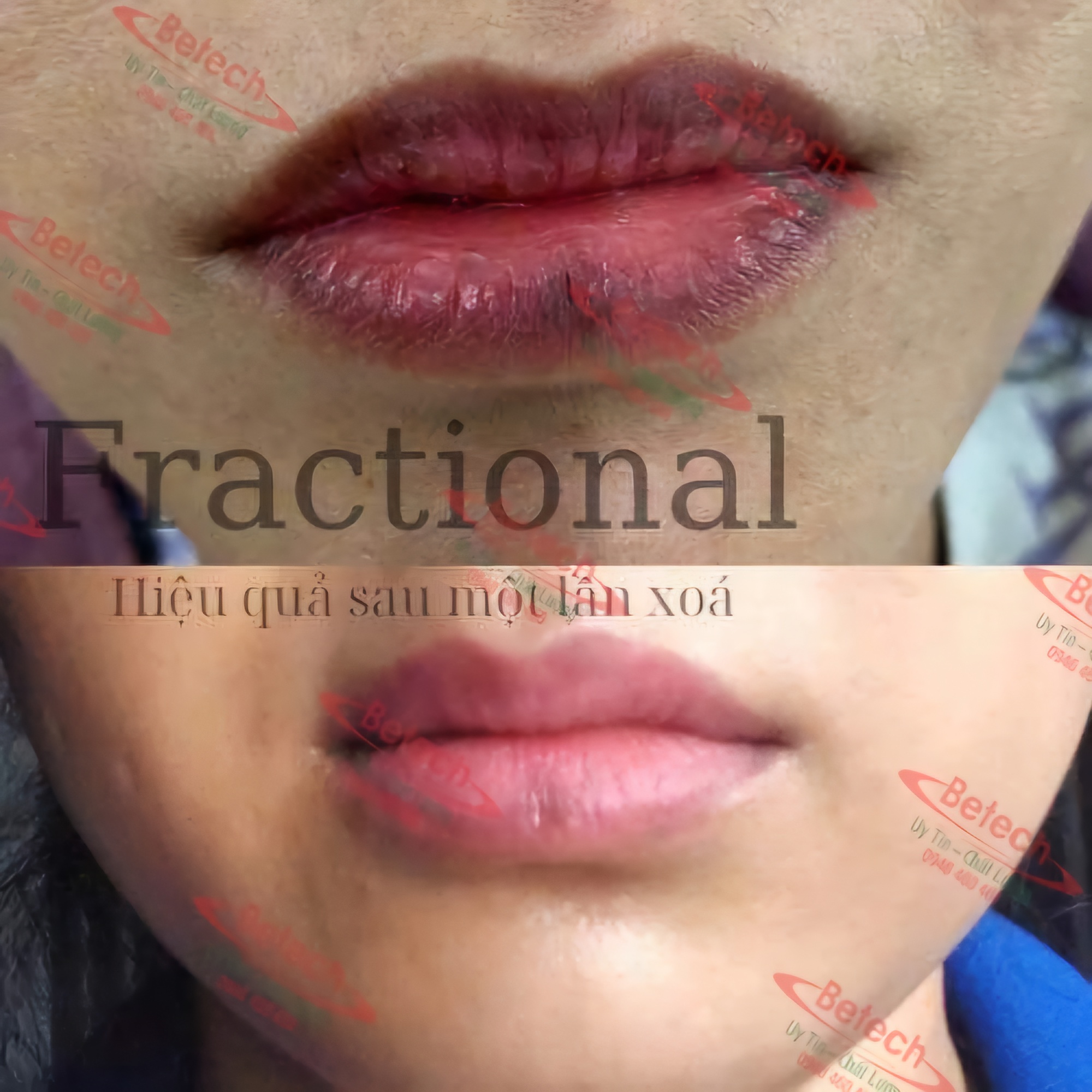 Máy laser co2 Be cell - Đột phá về công nghệ trị sẹo & tái tạo da 5 20241121 114334