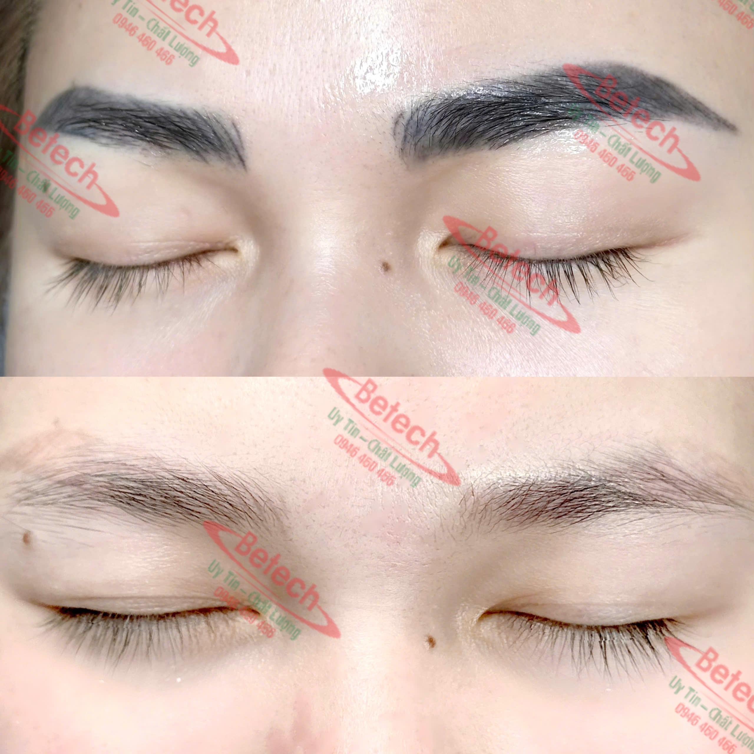 Máy Laser Pico One Plus – Xóa Xăm, Trị Nám, Trẻ Hóa Da Số 1 4 20241123 215858