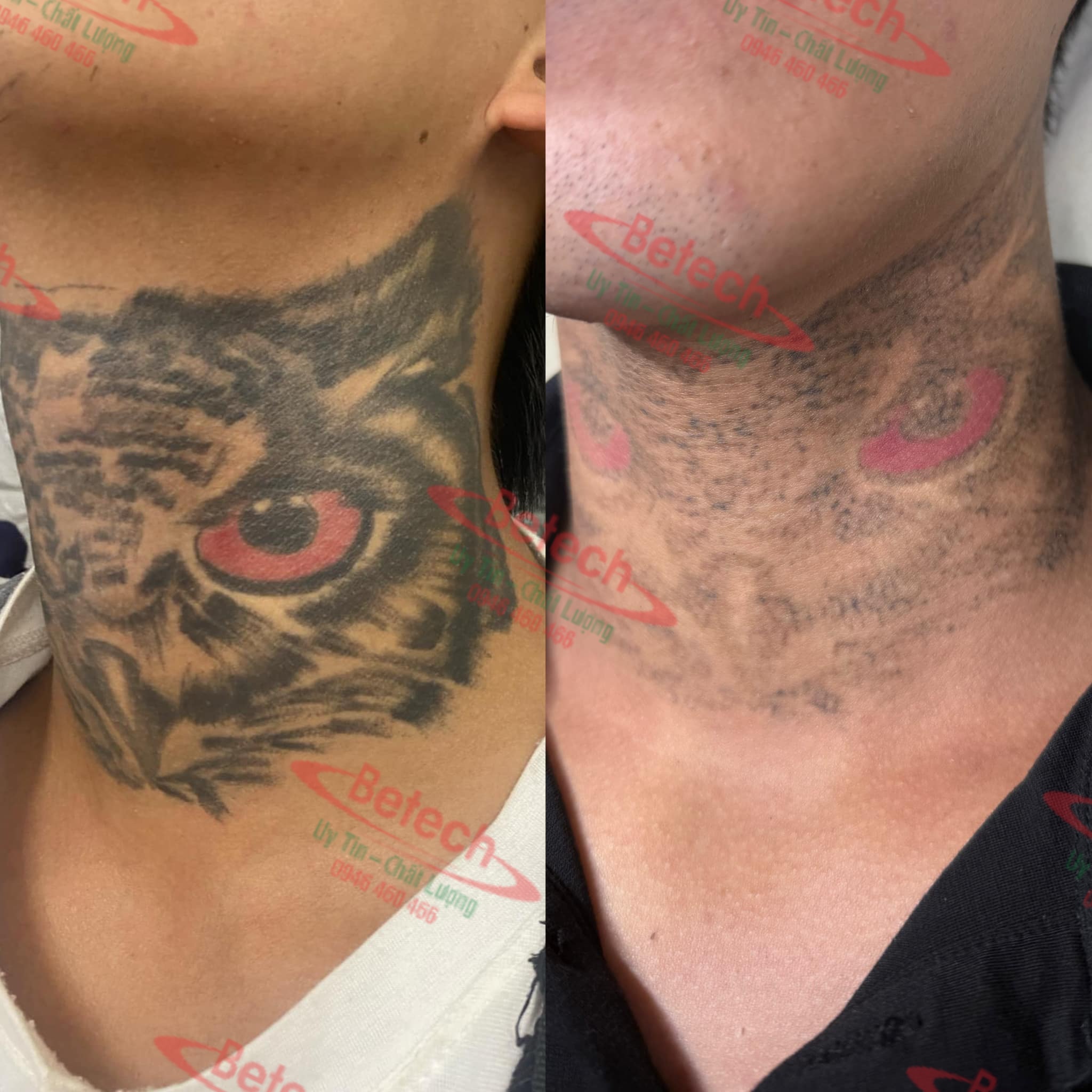 Máy Laser Pico One Plus – Xóa Xăm, Trị Nám, Trẻ Hóa Da Số 1 1 Messenger creation A920309D F1B4 45B3 A636 ECAE1D436356